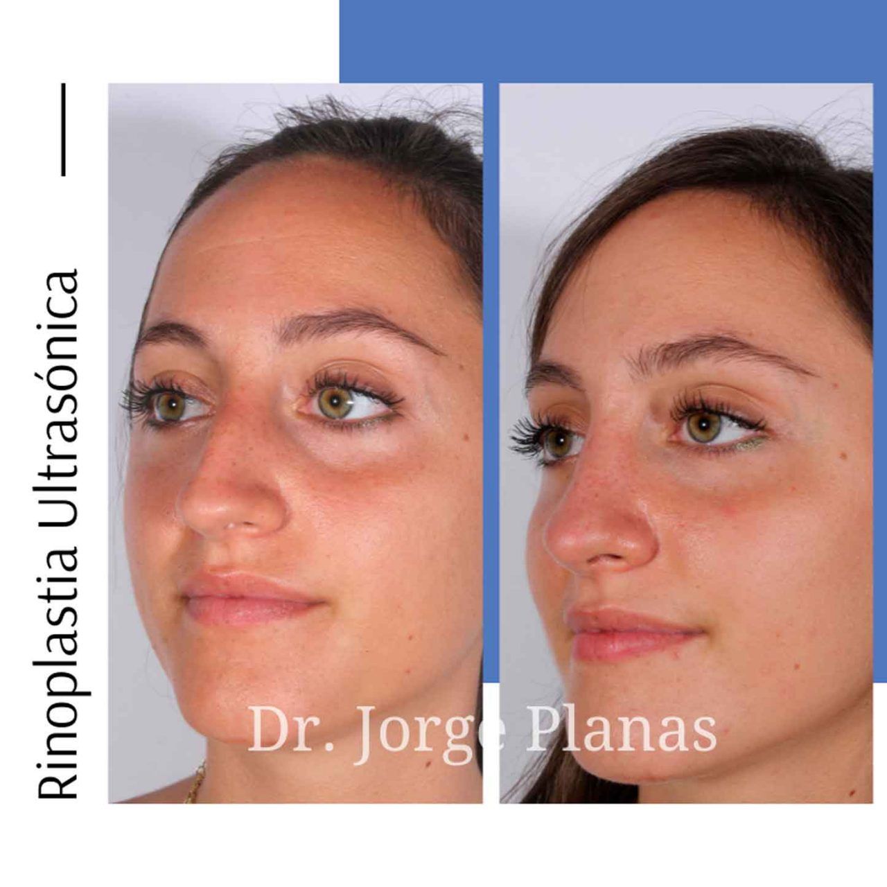 Rinoplastia Dr Jorge Planas Cirujano Pl stico Rinoplastia Dr Jorge Planas Cirujano Pl stico