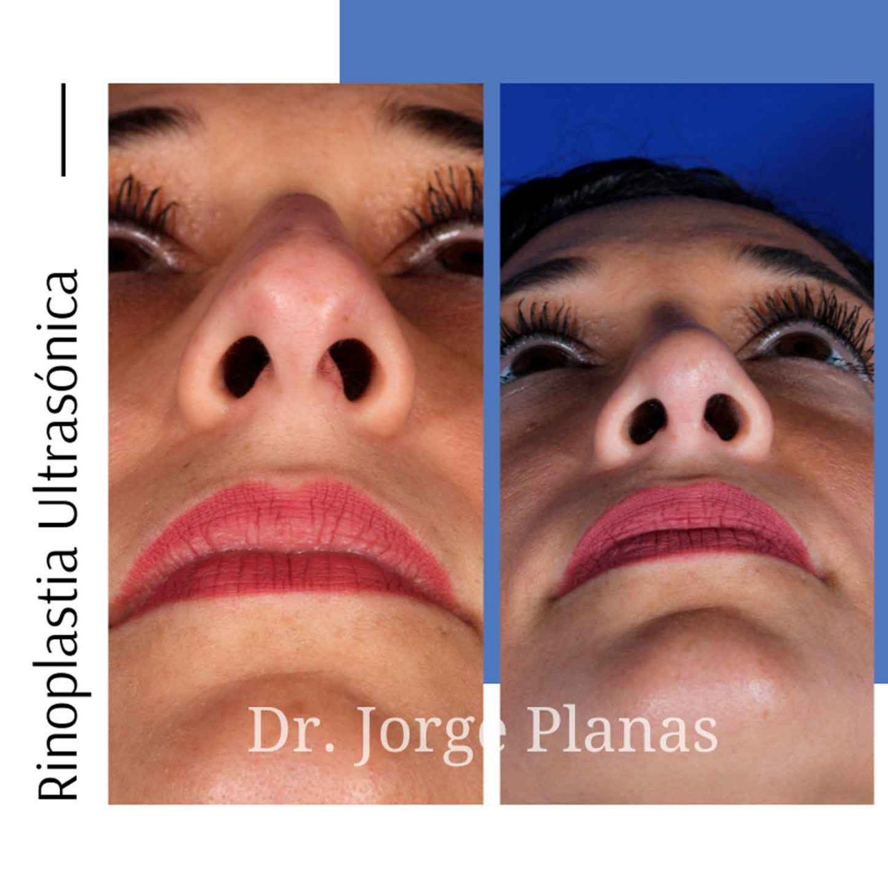 Rinoplastia Dr Jorge Planas Cirujano Pl stico Rinoplastia Dr Jorge Planas Cirujano Pl stico