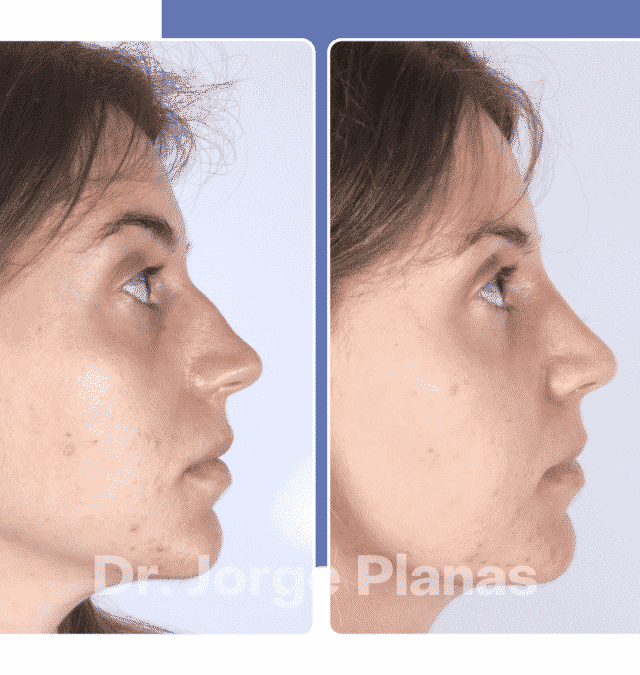 RINOPLASTIA ULTRA SÓNICA – Antes y después