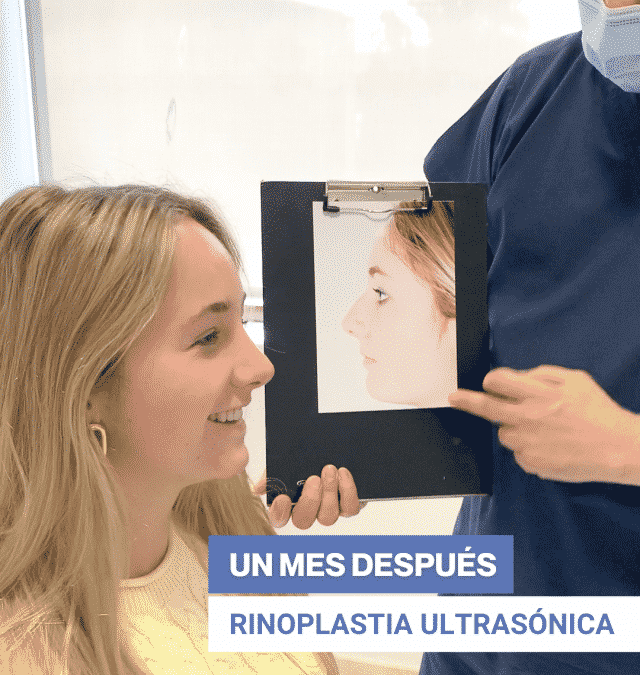 TESTIMONOI RINOPLASTIA Georgina