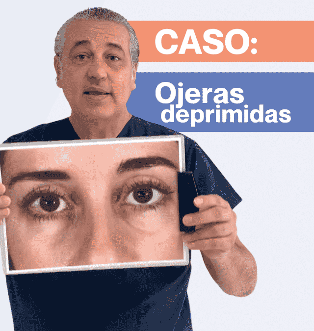 Caso de ojeras deprimidas