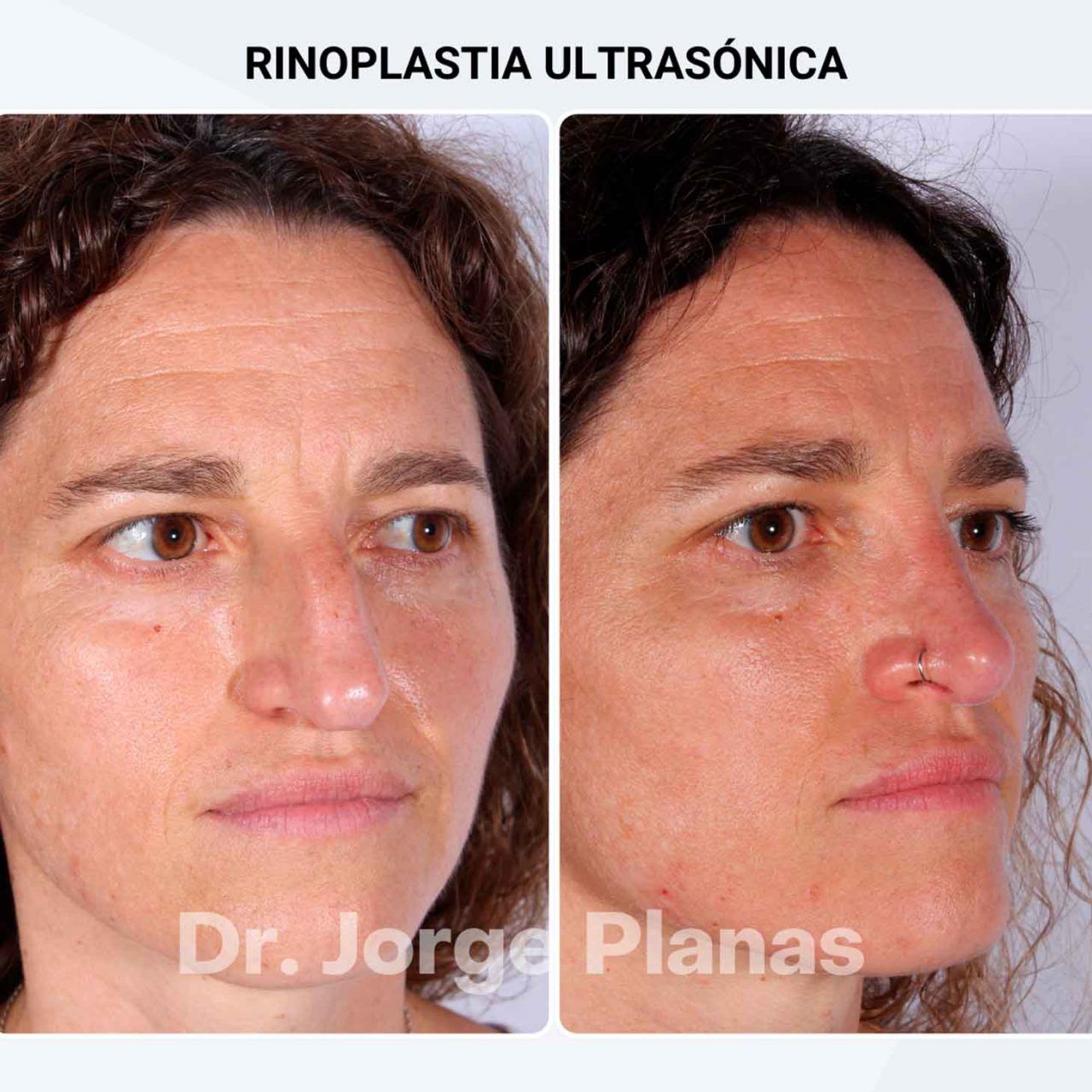 Rinoplastia Dr Jorge Planas Cirujano Pl stico Rinoplastia Dr Jorge Planas Cirujano Pl stico