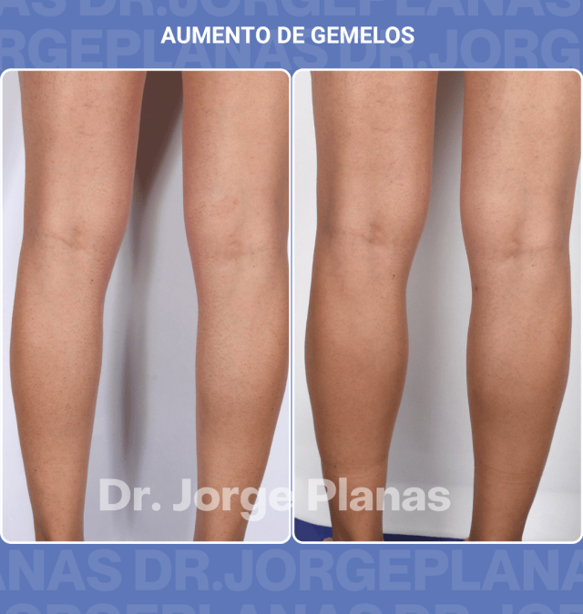 Aumento de gemelos con grasa