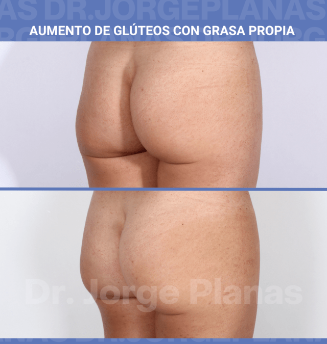 Caso de Aumento de Glúteos con grasa propia