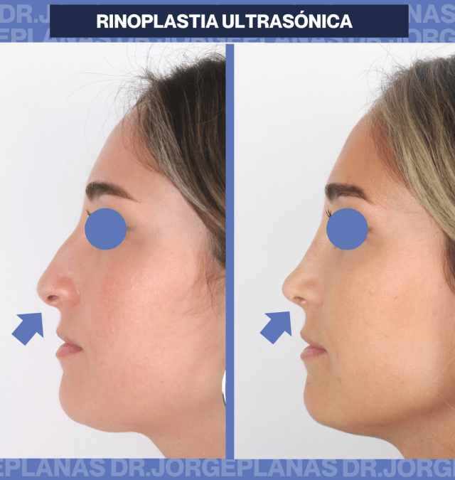 Resultado de una rinoplastia ultrasónica
