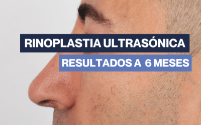Rinoplastia abierta &ndash; hombre