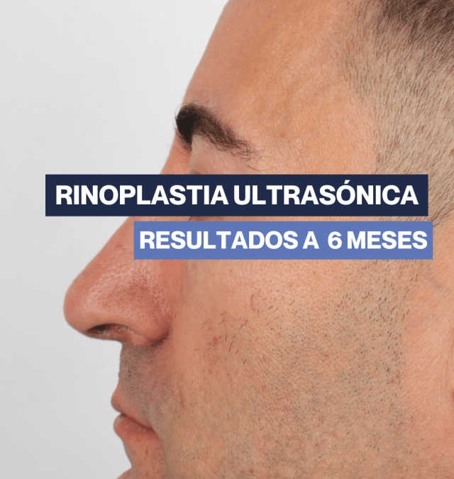 Rinoplastia abierta – hombre