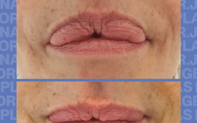 Extracci&oacute;n de relleno de labios