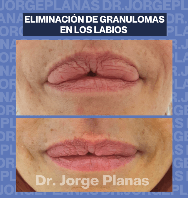 Extracción de relleno de labios