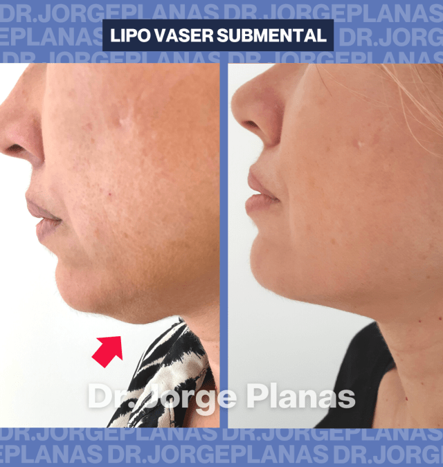 Caso de lipovaser de papada y cuello