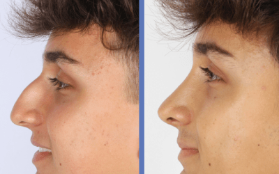 RINOPLASTIA &ndash; Cirug&iacute;a de nariz aguile&ntilde;a &ndash; Dr Jorge Planas