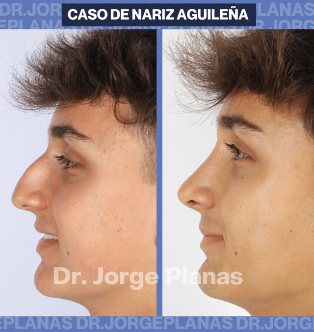 RINOPLASTIA – Cirugía de nariz aguileña – Dr Jorge Planas