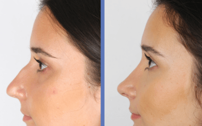 Resultado de una Rinoplastia
