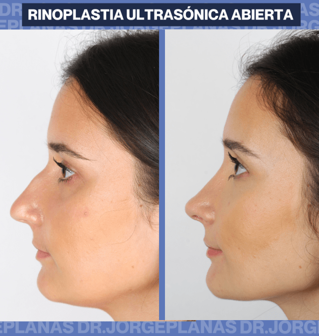 Resultado de una Rinoplastia