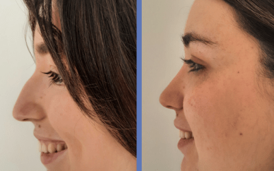 Testimonio de Sof&iacute;a RINOPLASTIA