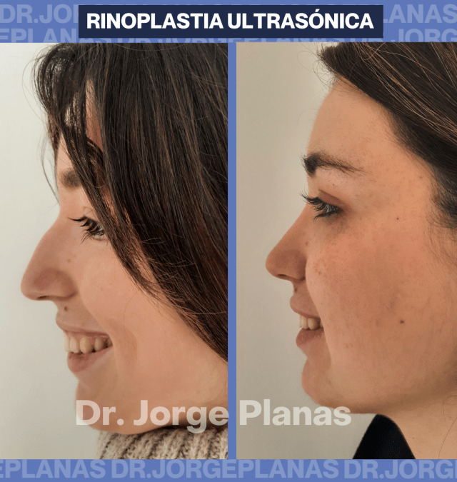 Testimonio de Sofía RINOPLASTIA