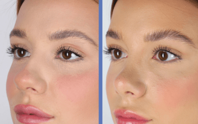 Rinoplastia ultras&oacute;nica NATURALIDAD