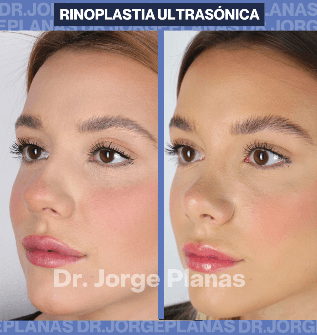 Rinoplastia ultrasónica NATURALIDAD