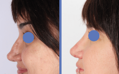 Reconstrucci&oacute;n de Nariz &ndash; Rinoplastia Caso real
