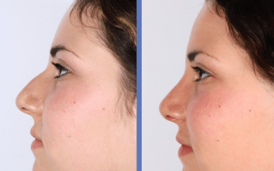 CASO REAL rinoplastia de Noa