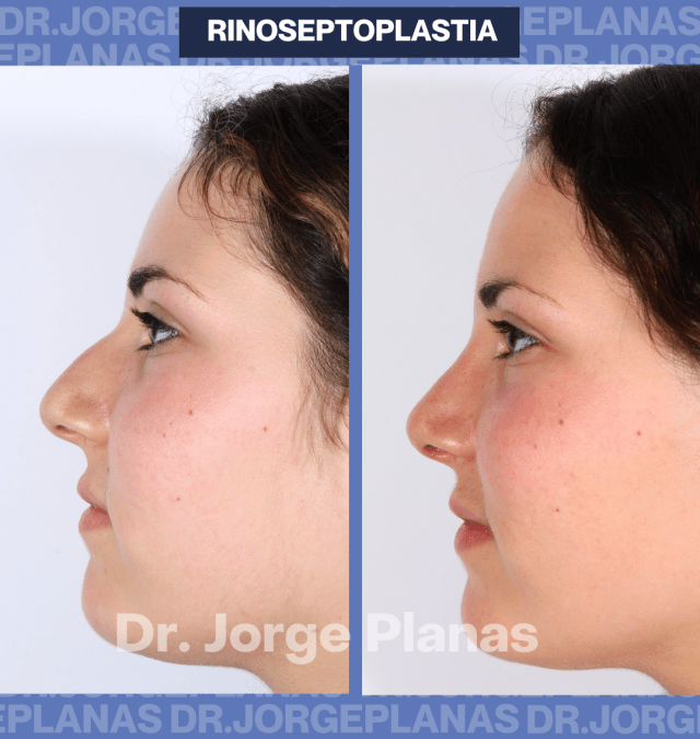 CASO REAL rinoplastia de Noa
