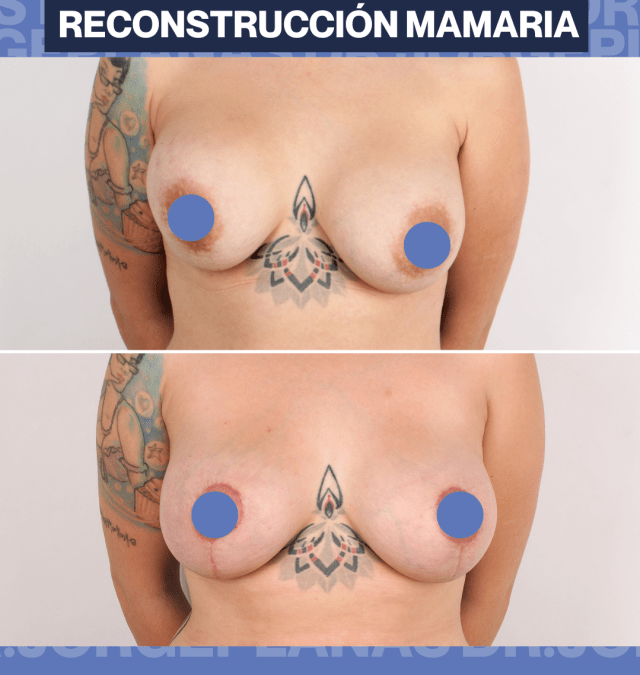 Reconstrucción mamaria  – Mireia