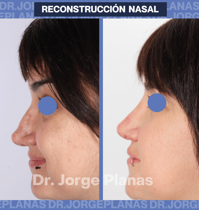 Reconstrucción de Nariz – Rinoplastia Caso real