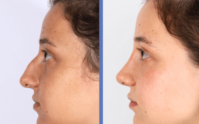 Caso de Rinoplastia &ndash; Neus