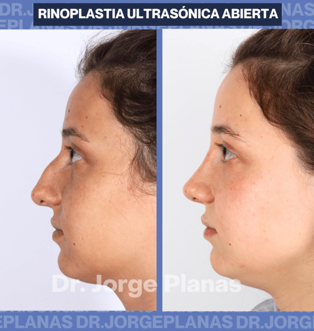 Caso de Rinoplastia – Neus