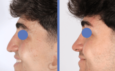 Naturalidad en una RINOPLASTIA de hombre