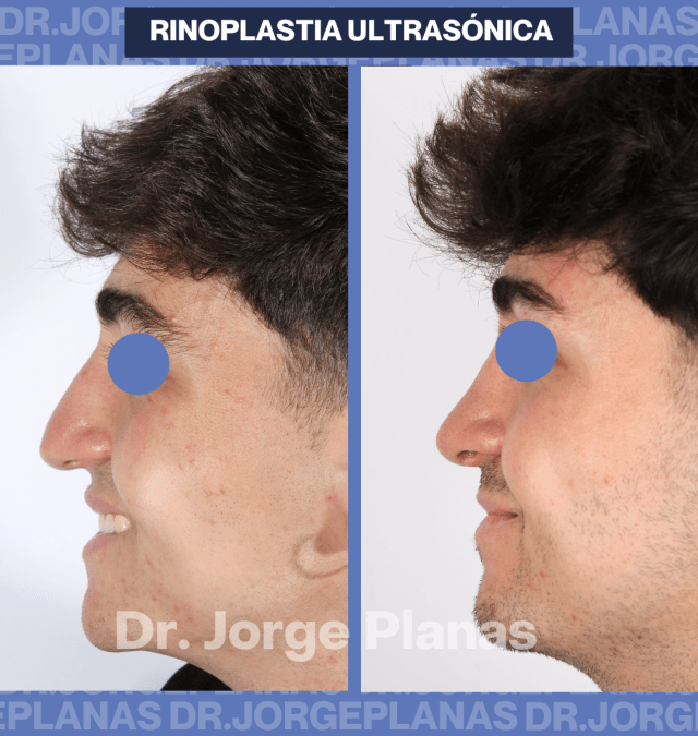 Naturalidad en una RINOPLASTIA de hombre