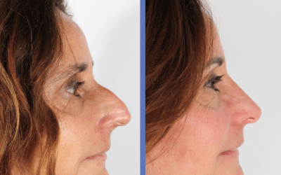 Caso real de RINOPLASTIA ultras&oacute;nica Abierta
