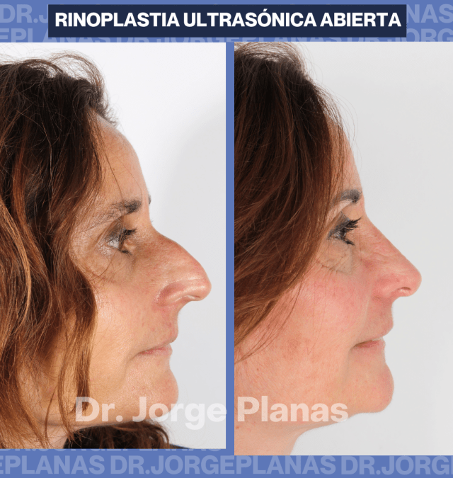 Caso real de RINOPLASTIA ultrasónica Abierta