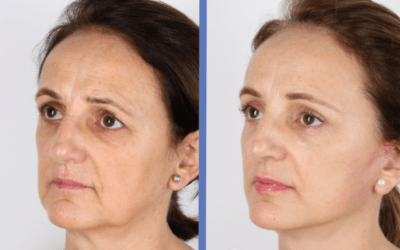 Caso real de mejora de envejecimiento facial. LIFTING