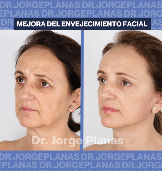Caso real de mejora de envejecimiento facial. LIFTING