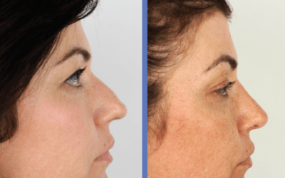 CASO real Mar&iacute;a RINOPLASTIA ULTRASONICA