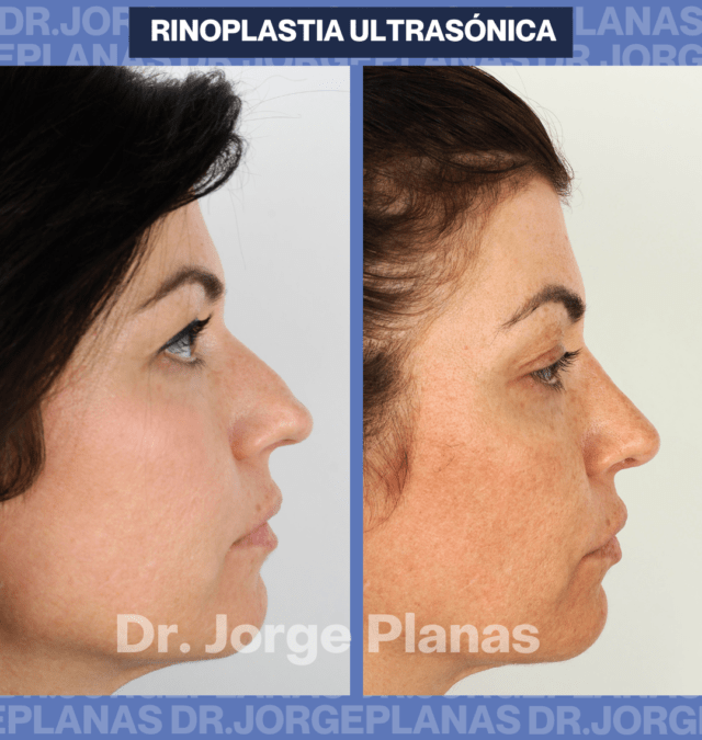 CASO real María RINOPLASTIA ULTRASONICA