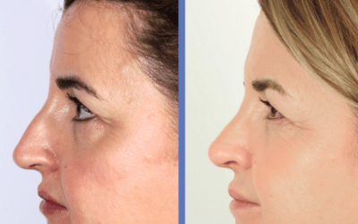 Rinoplastia ultras&oacute;nica cerrada.  caso real