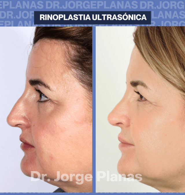 Rinoplastia ultrasónica cerrada.  caso real