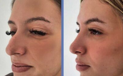 Caso real de Rinoplastia abierta