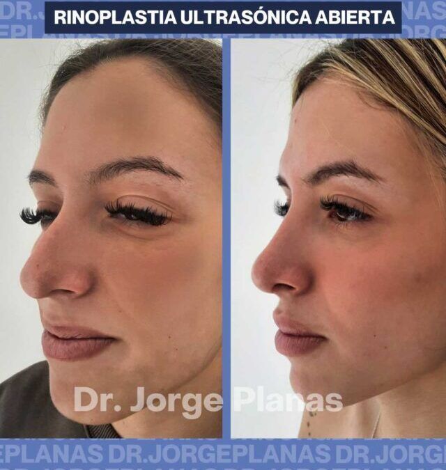 Caso real de Rinoplastia abierta