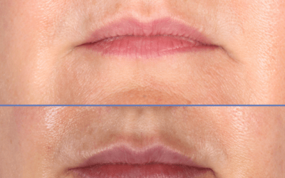 Aumento de labios con relleno reabsorbible