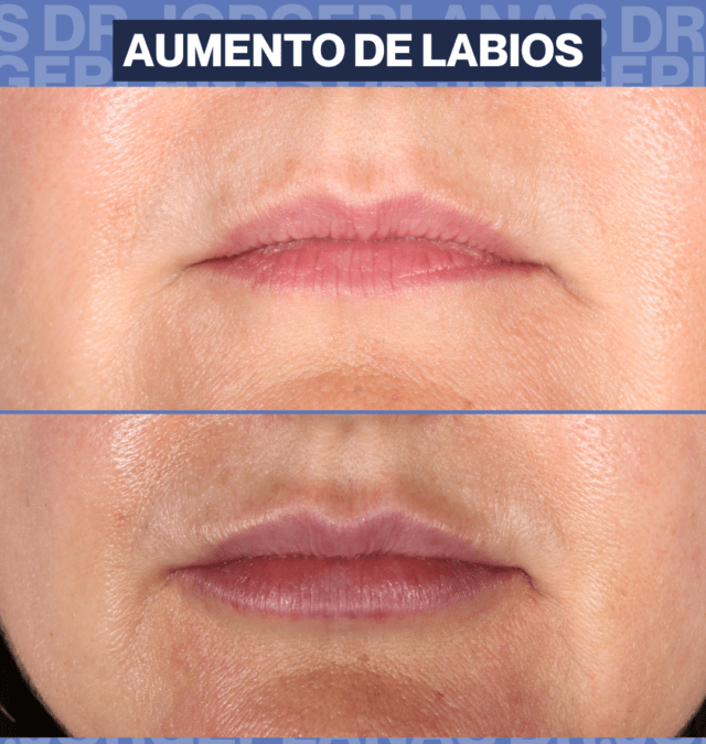 Aumento de labios con relleno reabsorbible