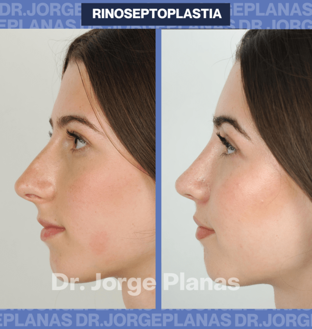 Rinoseptoplastia de Noelia, un caso especial