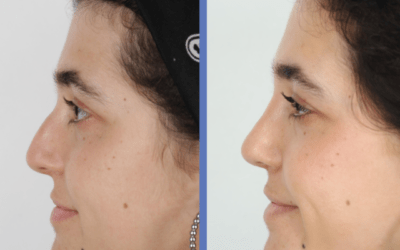 Rinoseptoplastia de Mireia, est&eacute;tica y funcional
