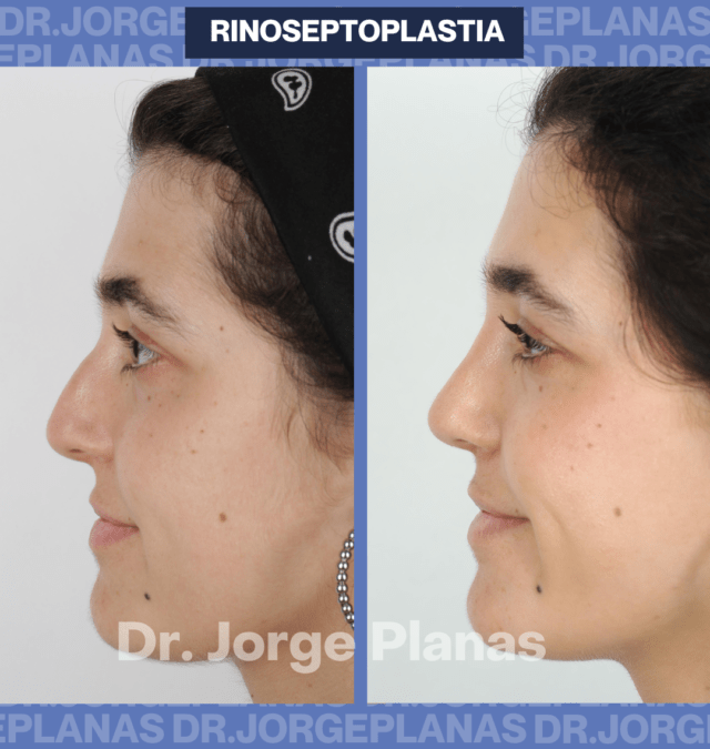 Rinoseptoplastia de Mireia, estética y funcional